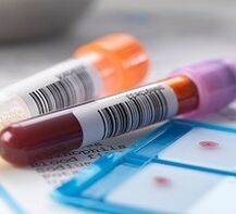Diagnose einer Laborprostatitis