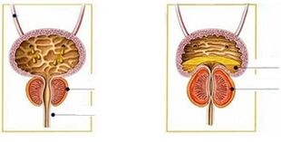 Arten und Formen von Prostatitis bei Männern