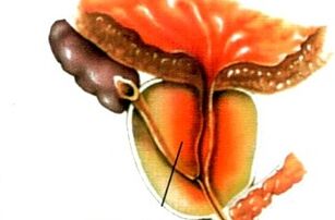 Was ist Prostatitis bei Männern