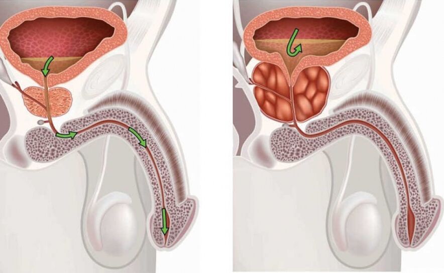 Gesunde und entzündete Prostata.