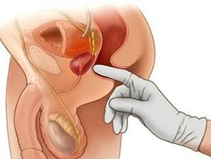 Prostatamassage zur Behandlung von Prostatitis bei Männern.