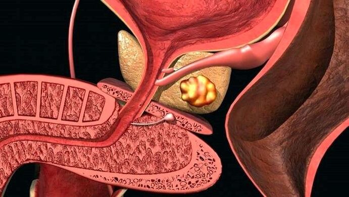 Steinablagerungen in der Prostata bei kalkhaltiger Prostatitis.
