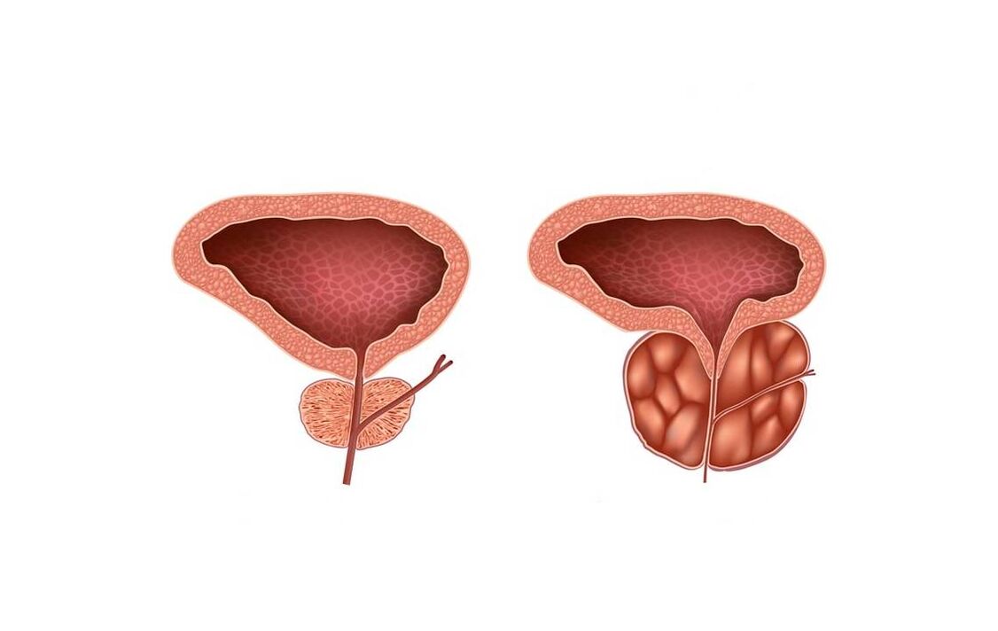 Prostatitis-Symptome bei Männern
